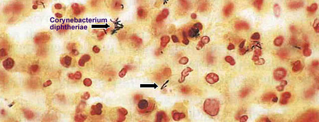 qmph-web-difteria-corynebacterium_diphtheriae.jpg