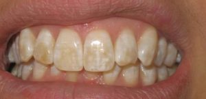 qmph-blog-terapiacionismo-fluorosis